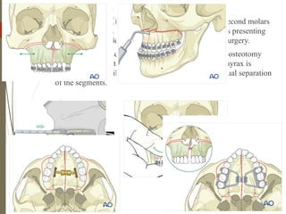 70
 A hyrax appliance is bonded to the maxillary first or second molars
and first or second premolar, depending on the patients presenting
dentition. This is done usually 1 or 2 days before the surgery.
 After the down fracturing of the maxilla as in Lefort I osteotomy
during standard orthognathic surgery procedures, the hyrax is
activated and maxilla is expanded 2mm to achieve visual separation
of the segments.
 
