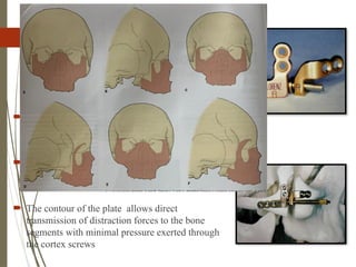 71
Mid Face DO
 Two plate like devices that are joined by a
threaded rod
 When assembled the plate components separate
as the threaded rod is turned
 The contour of the plate allows direct
transmission of distraction forces to the bone
segments with minimal pressure exerted through
the cortex screws
 