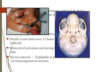 73
 Prior soft tissue closure the devices are activated & device
assessed to verify that anchorage is secure & distraction
vector is also assessed
 Surgical site closure
 protocol:
 On first post op day device is activated to 2mm
 Device is activated every 12 hours till desired position is
achieved
 Removal of activation rod leaving the device in submerged
state
 Device removal  if palpable or producing contour deformity
via transconjunctival incision
 