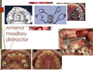 74
Anterior
maxillary
distractor
 