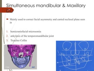 75
Simultaneous mandibular & Maxillary
DO
 Mainly used to correct facial asymmetry and canted occlusal plane seen
in
1. hemicraniofacial microsomia
2. ankylosis of the temporomandibular joint
3. Treacher Collin
 