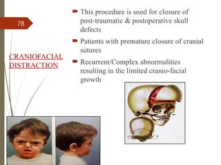 78
CRANIOFACIAL
DISTRACTION
 This procedure is used for closure of
post-traumatic & postoperative skull
defects
 Patients with premature closure of cranial
sutures
 Recurrent/Complex abnormalities
resulting in the limited cranio-facial
growth
 