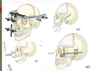79 Surgical techniques and osteotomies :
a) Monobloc and fronto orbital osteotomies
b) Bitemporal craniotomy
c) Le fort III osteotomies
Suggested advantages over conventional techniques of cranial vault
reconstruction includes:
d) Potential risk of metallic plate migration eliminated
e) Reduction in the surgical dissection
f) Resorption of the bone segments does not occur
 