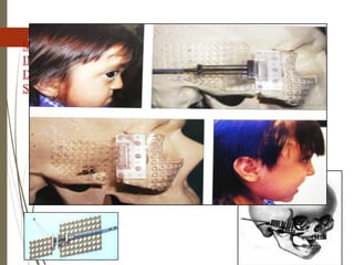 80
MODULAR
INTERNAL
DISTRACTOR
S
 Cohen et al -a system of miniature distractors that
could be customized for use anywhere in the
craniofacial complex.
 Depending on the distraction site and osteotomy,
any configuration of titanium plates can be
attached to the distraction screw to permit
uniplanar and possibly biplanar internal
distraction.
 A flexible activation cable is brought out through
a distant, inconspicuous stab wound in the hair
behind the ear.
 