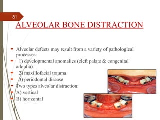 81
ALVEOLAR BONE DISTRACTION
 Alveolar defects may result from a variety of pathological
processes:
 1) developmental anomalies (cleft palate & congenital
adontia)
 2) maxillofacial trauma
 3) periodontal disease
 Two types alveolar distraction:
 A) vertical
 B) horizontal
 