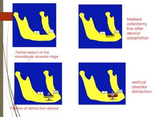 82
Partial defect of the
mandibular alveolar ridge
Marked
osteotomy
line after
device
adaptation
Position of distraction device
vertical
alveolar
distraction.
 