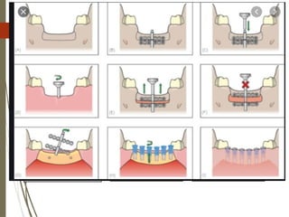 83
 The mucoperiosteal flap is elevated at the augmentation site &
a U-shaped osteotomy of the alveolar bone is performed,
forming the transport alveolar bone segment
 Alveolar reconstruction is achieved by a bone transport
technique whereby the transport segment would be moved
using a special distractor
 