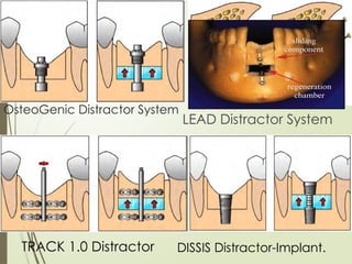 84
OsteoGenic Distractor System
LEAD Distractor System
TRACK 1.0 Distractor DISSIS Distractor-Implant.
 
