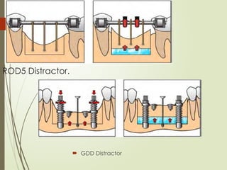 85
ROD5 Distractor.
 GDD Distractor
 
