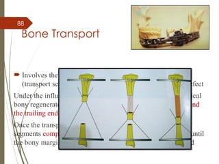 88
Bone Transport
 Involves the gradual movement of a free segment of bone
(transport segment or transport disc) across the osseous defect
Under the influence of tensional stresses DO occurs and typical
bony regenerate is formed b/w residual host bone segments and
the trailing end of the transport segments
Once the transport bone segment reaches the residual bone
segments compression forces are applied at the docking site until
the bony margins of the transport & target segments are fused
 