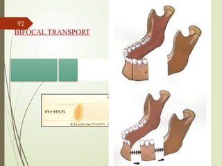 92
BIFOCAL TRANSPORT
 