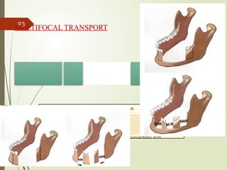 93
MULTIFOCAL TRANSPORT
 