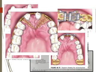 96
 Pins placed through separate stab incision.
 Device applied and vector checked.corticotomy then
converted to osteotomy. Device is then applied firmly in the
preset orientation.
 Mobilization of the discs checked.
 Ilizarov principles are then followed.
 leading edge of the transport disc becomes rounded and
surrounded by fibrocartilagenous cap,which must be
removed surgically to allow for osseous continuity ,
removal is done at the time of the device removal.
 And bone plate for rigid fixation is placed between docking
site and transport disc.
 