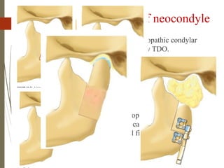 99
TDO- reconstruction of neocondyle
 Dentofacial deformities as a result of idiopathic condylar
resorption,ankylosis etc can be treated by TDO.
 Once bony ankylosis is released, a transport disc is created
by reverse L osteotomy from the sigmoid notch to approx 1
cm above angle of mandible.
 Corticotomy followed by osteotomy.
 Ilizarov principles are followed.
 As the leading edge becomes enveloped with
fibrocartilagenous cap, active physical therapy started,
during distraction phase and neutral fixation.
 