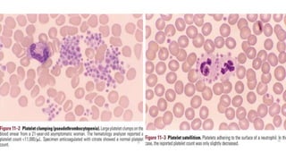 Platelet disorders- qualitative and quantitative | PPTX