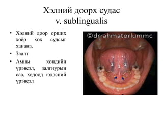 Хэлний доорх судас
v. sublingualis
• Хэлний доор орших
хоёр хөх судсыг
ханана.
• Заалт
• Амны хөндийн
үрэвсэл, залгиурын
саа, ходоод гэдэсний
үрэвсэл
 