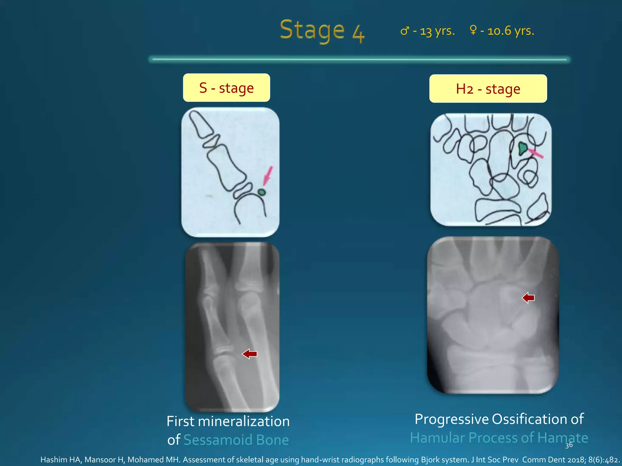 Hand Wrist Radiography | PPTX