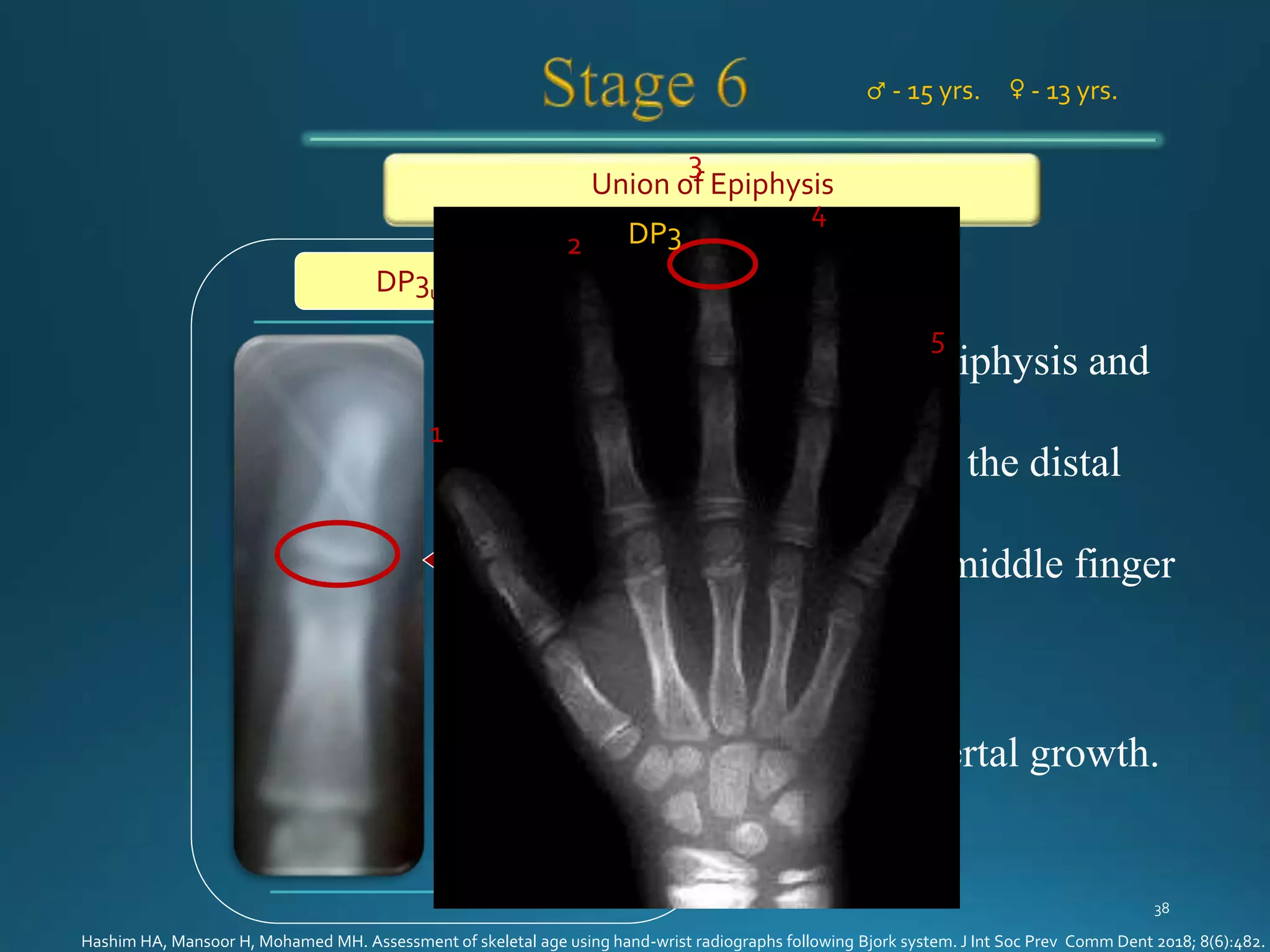 Hand Wrist Radiography | PPTX