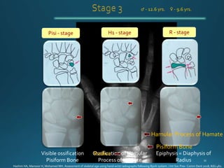 H1 - stage
Visible ossification
Pisiform Bone
Pisi - stage R - stage
Ossification of Hamular
Process of Hamate
Epiphysis = Diaphysis of
Radius
♂ - 12.6 yrs. ♀ - 9.6 yrs.
Pisiform Bone
Hamular Process of Hamate
Radius
Hashim HA, Mansoor H, Mohamed MH. Assessment of skeletal age using hand-wrist radiographs following Bjork system. J Int Soc Prev Comm Dent 2018; 8(6):482.
 