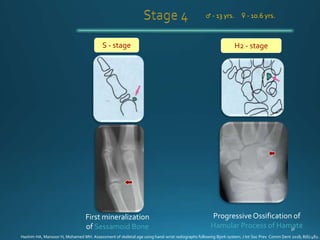 H2 - stage
First mineralization
of Sessamoid Bone
S - stage
ProgressiveOssification of
Hamular Process of Hamate
♂ - 13 yrs. ♀ - 10.6 yrs.
Hashim HA, Mansoor H, Mohamed MH. Assessment of skeletal age using hand-wrist radiographs following Bjork system. J Int Soc Prev Comm Dent 2018; 8(6):482.
 