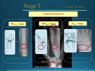 1
3
2
4
5
Capping of Epiphysis
PP1cap - stage MP3cap - stage
Peak of the Pubertal growth
♂ - 14 yrs. ♀ - 11 yrs.
Rcap - stage
PP1
MP3
Radius
Hashim HA, Mansoor H, Mohamed MH. Assessment of skeletal age using hand-wrist radiographs following Bjork system. J Int Soc Prev Comm Dent 2018; 8(6):482.
 