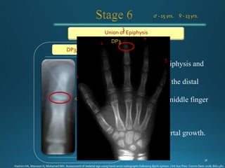 Union of Epiphysis
♂ - 15 yrs. ♀ - 13 yrs.
DP3u - stage
1
3
2
4
5
DP3
Hashim HA, Mansoor H, Mohamed MH. Assessment of skeletal age using hand-wrist radiographs following Bjork system. J Int Soc Prev Comm Dent 2018; 8(6):482.
 