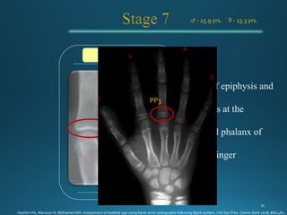 ♂ - 15.9 yrs. ♀ - 13.3 yrs.
PP3u - stage
1
3
2
4
5
PP3
Hashim HA, Mansoor H, Mohamed MH. Assessment of skeletal age using hand-wrist radiographs following Bjork system. J Int Soc Prev Comm Dent 2018; 8(6):482.
 