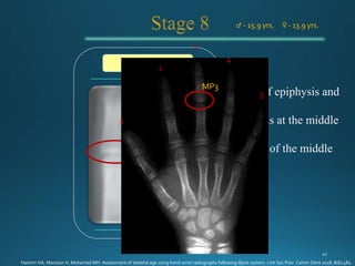 ♂ - 15.9 yrs. ♀ - 13.9 yrs.
MP3u - stage
1
3
2
4
5
MP3
Hashim HA, Mansoor H, Mohamed MH. Assessment of skeletal age using hand-wrist radiographs following Bjork system. J Int Soc Prev Comm Dent 2018; 8(6):482.
 