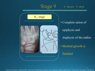 • Skeletal growth is
finished
♂ - 18.5 yrs. ♀ - 16 yrs.
Ru - stage
Hashim HA, Mansoor H, Mohamed MH. Assessment of skeletal age using hand-wrist radiographs following Bjork system. J Int Soc Prev Comm Dent 2018; 8(6):482.
 