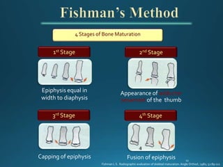 4 Stages of Bone Maturation
Epiphysis equal in
width to diaphysis
Appearance of adductor
sesamoid of the thumb
Capping of epiphysis Fusion of epiphysis
1st Stage 2nd Stage
3rd Stage 4th Stage
Fishman L S. Radiographic evaluation of skeletal maturation. Angle Orthod ; 1982; 52:89-111
 