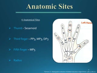 6 Anatomical Sites
 Thumb - Sesamoid
 Third finger – PP3, MP3, DP3
 Fifth finger – MP5
 Radius
Fishman L S. Radiographic evaluation of skeletal maturation. Angle Orthod ; 1982; 52:89-111
 