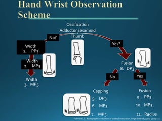 Ossification
Adductor sesamoid
Thumb
No?
Width
1. PP3
Width
2. MP3
Width
3. MP5
Yes?
Fusion
8. DP3
Capping Fusion
5. DP3
6. MP3
7. MP5
9. PP3
10. MP3
11. Radius
No Yes
Fishman L S. Radiographic evaluation of skeletal maturation. Angle Orthod ; 1982; 52:89-111
 