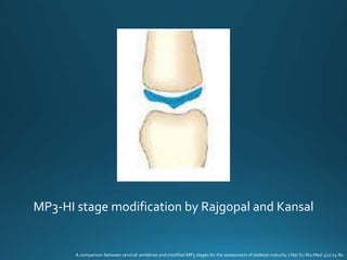 MP3-HI stage modification by Rajgopal and Kansal
A comparison between cervical vertebrae and modified MP3 stages for the assessment of skeletal maturity J Nat Sci Bio Med 4(1):74-80
 