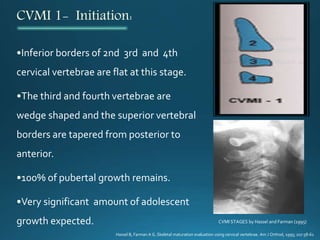CVMI 1- Initiation:
•Inferior borders of 2nd 3rd and 4th
cervical vertebrae are flat at this stage.
•The third and fourth vertebrae are
wedge shaped and the superior vertebral
borders are tapered from posterior to
anterior.
•100% of pubertal growth remains.
•Very significant amount of adolescent
growth expected. CVMI STAGES by Hassel and Farman (1995)
Hassel B, Farman A G. Skeletal maturation evaluation using cervical vertebrae. Am J Orthod, 1995; 107:58-61
 