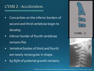 CVMI 2 -Acceleration:
• Concavities on the inferior borders of
second and third vertebrae begin to
develop.
• Inferior border of fourth vertebrae
remains flat.
• Vertebral bodies of third and fourth
are nearly rectangular in shape.
• 65-85% of pubertal growth remains.
Hassel B, Farman A G. Skeletal maturation evaluation using cervical vertebrae. Am J Orthod, 1995; 107:58-61
 