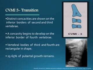 CVMI 3- Transition
•Distinct concavities are shown on the
inferior borders of second and third
vertebrae.
• A concavity begins to develop on the
inferior border of fourth vertebrae.
•Vertebral bodies of third and fourth are
rectangular in shape.
• 25-65% of pubertal growth remains.
Hassel B, Farman A G. Skeletal maturation evaluation using cervical vertebrae. Am J Orthod, 1995; 107:58-61
 
