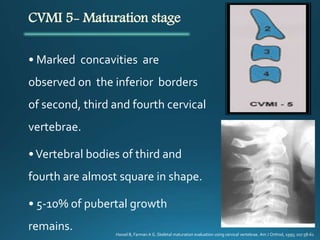 CVMI 5- Maturation stage
• Marked concavities are
observed on the inferior borders
of second, third and fourth cervical
vertebrae.
•Vertebral bodies of third and
fourth are almost square in shape.
• 5-10% of pubertal growth
remains. Hassel B, Farman A G. Skeletal maturation evaluation using cervical vertebrae. Am J Orthod, 1995; 107:58-61
 