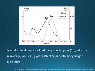 Frontal sinus shows a well defined pubertal peak (Sp), which on
an average, occurs 1.4 years after the pubertal body height
peak. (Bp).
Ruf S, Pancherz H. Frontal sinus development as an indicator for somatic maturity at puberty?. Am J Orthod Dentofac Orthop 1996 1;110(5):476-82.
 
