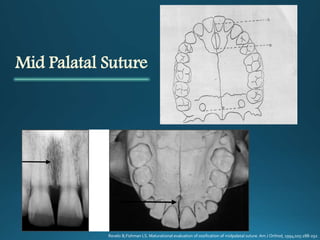 Mid Palatal Suture
Revelo B,Fishman LS. Maturational evaluation of ossification of midpalatal suture. Am J Orthod, 1994;105:288-292
 