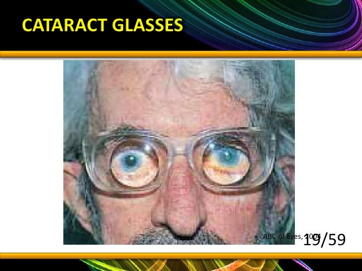 cataracts and sunglasses