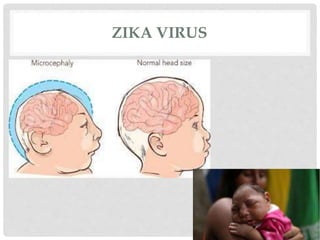 ZIKA VIRUS
 