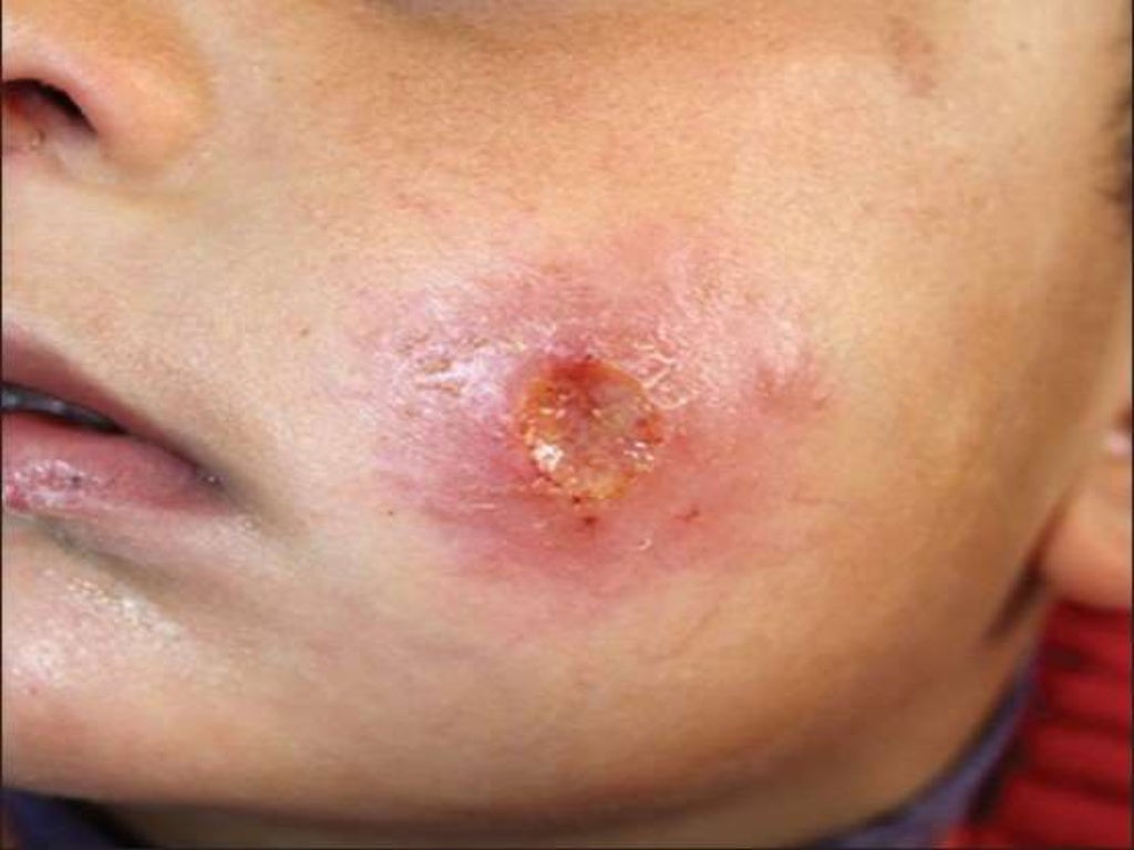 Vector Borne Disease