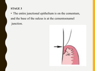 STAGE 3
• The entire junctional epithelium is on the cementum,
and the base of the sulcus is at the cementoenamel
junction.
 