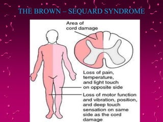 THE BROWN – SEQUARD SYNDROME
 