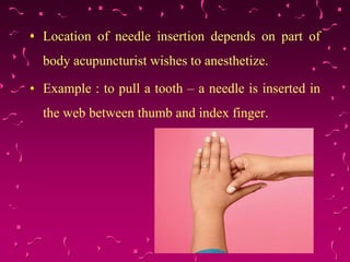 • Location of needle insertion depends on part of
body acupuncturist wishes to anesthetize.
• Example : to pull a tooth – a needle is inserted in
the web between thumb and index finger.
 