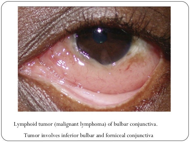 Ocular Lymphoma - 