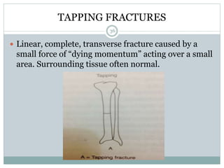TAPPING FRACTURES
 Linear, complete, transverse fracture caused by a
small force of “dying momentum” acting over a small
area. Surrounding tissue often normal.
36
 