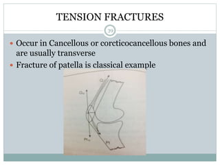TENSION FRACTURES
 Occur in Cancellous or corcticocancellous bones and
are usually transverse
 Fracture of patella is classical example
39
 