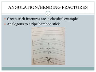 ANGULATION/BENDING FRACTURES
 Green stick fractures are a classical example
 Analogous to a ripe bamboo stick
41
 