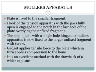 MULLERS APPARATUS
 Plate is fixed to the smaller fragment.
 Hook of the tension apparatus with the jaws fully
open is engaged to the notch in the last hole of the
plate overlying the unfixed fragment.
 The small plate with a single hole hinged to mullers
apparatus is now fixed to the larger unfixed fragment
with screw.
 Gadget applies tensile force to the plate which in
turn applies compression to the bone
 It is an excellent method with the drawback of a
wider exposure
94
 